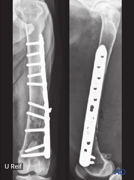 Fractures in Canines: Types, Symptoms, Diagnosis, Treatment, and Recovery - All Creatures Veterinary Center Surgical procedures